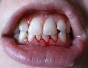 bleeding gums gingivitis 300x232 1